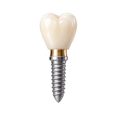 Implant Crowns from Our Dental Implant Lab